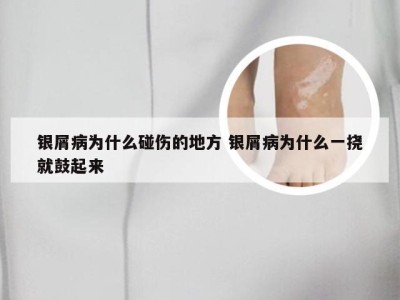 银屑病为什么碰伤的地方 银屑病为什么一挠就鼓起来