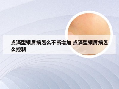点滴型银屑病怎么不断增加 点滴型银屑病怎么控制