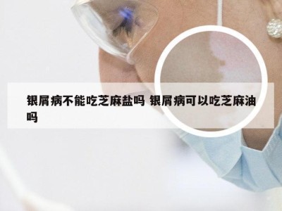 银屑病不能吃芝麻盐吗 银屑病可以吃芝麻油吗