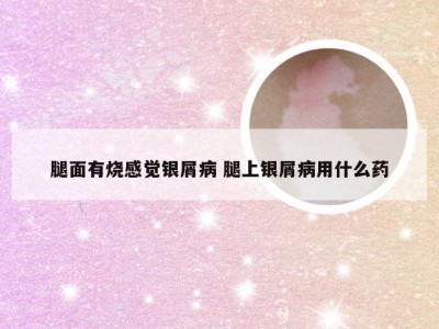 腿面有烧感觉银屑病 腿上银屑病用什么药