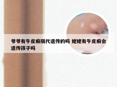 爷爷有牛皮癣隔代遗传的吗 姥姥有牛皮癣会遗传孩子吗