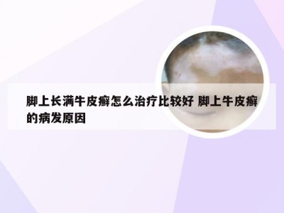脚上长满牛皮癣怎么治疗比较好 脚上牛皮癣的病发原因