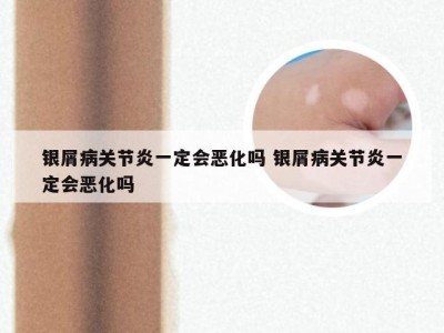 银屑病关节炎一定会恶化吗 银屑病关节炎一定会恶化吗