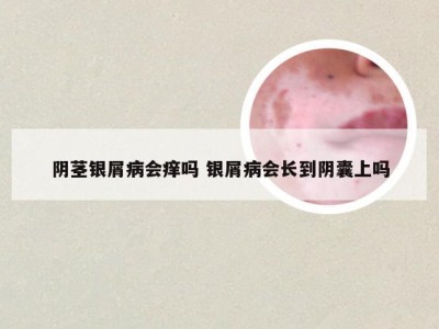 阴茎银屑病会痒吗 银屑病会长到阴囊上吗