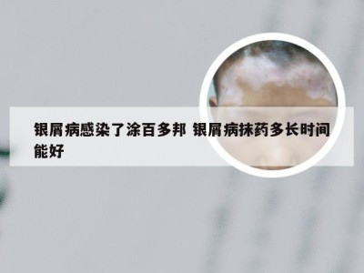 银屑病感染了涂百多邦 银屑病抹药多长时间能好
