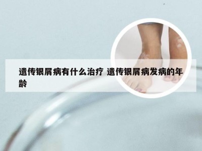 遗传银屑病有什么治疗 遗传银屑病发病的年龄