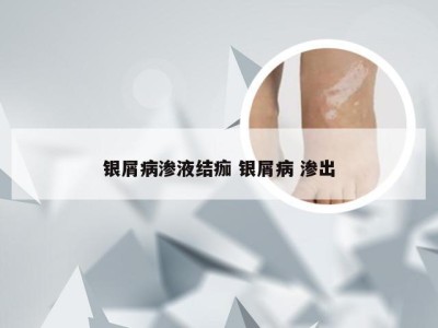 银屑病渗液结痂 银屑病 渗出