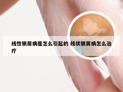 线性银屑病是怎么引起的 线状银屑病怎么治疗