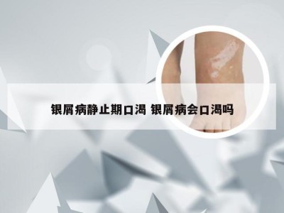 银屑病静止期口渴 银屑病会口渴吗