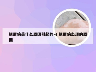 银屑病是什么原因引起的刁 银屑病出现的原因