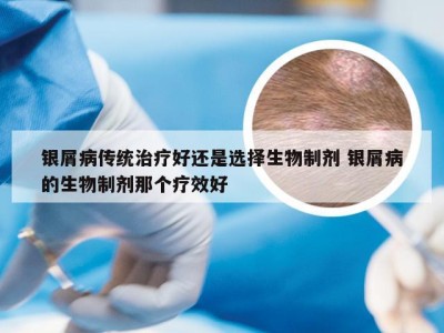 银屑病传统治疗好还是选择生物制剂 银屑病的生物制剂那个疗效好