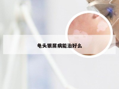 龟头银屑病能治好么