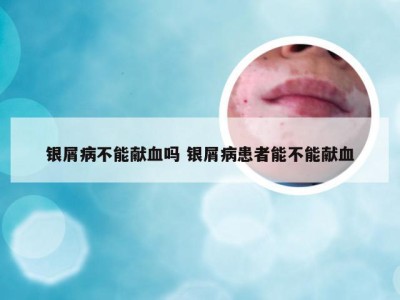 银屑病不能献血吗 银屑病患者能不能献血