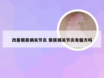 改善银屑病关节炎 银屑病关节炎有偏方吗