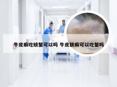 牛皮癣吃螃蟹可以吗 牛皮肤癣可以吃蟹吗