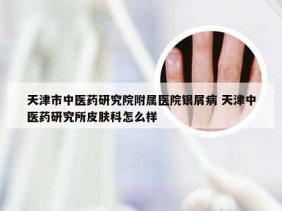 天津市中医药研究院附属医院银屑病 天津中医药研究所皮肤科怎么样