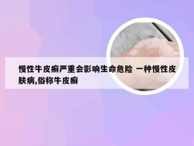 慢性牛皮癣严重会影响生命危险 一种慢性皮肤病,俗称牛皮癣