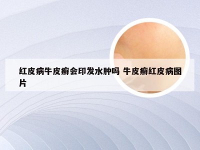 红皮病牛皮癣会印发水肿吗 牛皮癣红皮病图片