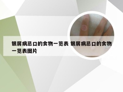 银屑病忌口的食物一览表 银屑病忌口的食物一览表图片