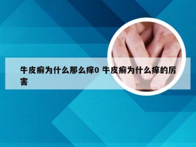 牛皮癣为什么那么痒0 牛皮癣为什么痒的厉害