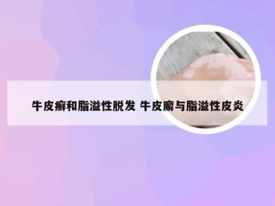 牛皮癣和脂溢性脱发 牛皮廨与脂溢性皮炎