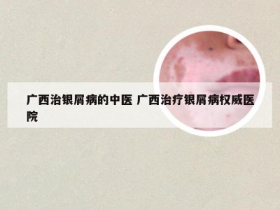 广西治银屑病的中医 广西治疗银屑病权威医院