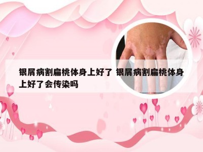 银屑病割扁桃体身上好了 银屑病割扁桃体身上好了会传染吗