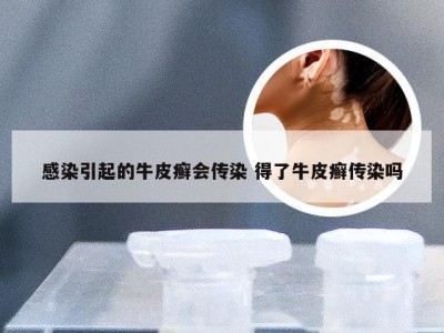 感染引起的牛皮癣会传染 得了牛皮癣传染吗