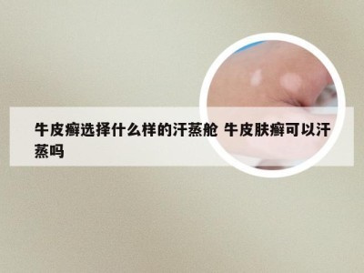 牛皮癣选择什么样的汗蒸舱 牛皮肤癣可以汗蒸吗