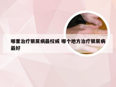 哪里治疗银屑病最权威 哪个地方治疗银屑病最好