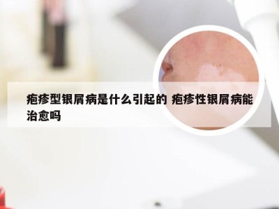 疱疹型银屑病是什么引起的 疱疹性银屑病能治愈吗