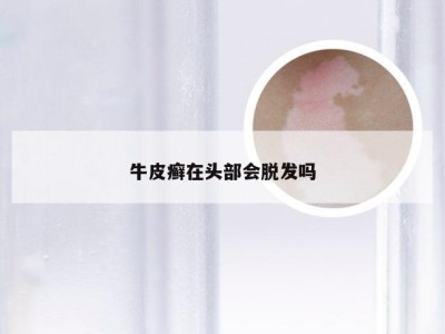 牛皮癣在头部会脱发吗