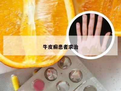 牛皮癣患者求治