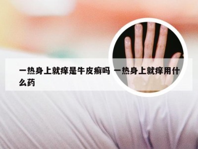 一热身上就痒是牛皮癣吗 一热身上就痒用什么药