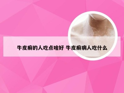 牛皮癣的人吃点啥好 牛皮癣病人吃什么