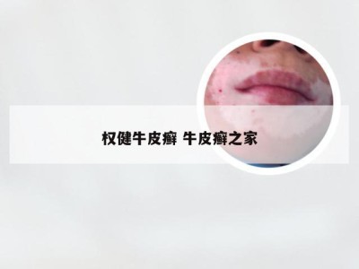 权健牛皮癣 牛皮癣之家