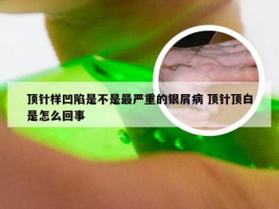 顶针样凹陷是不是最严重的银屑病 顶针顶白是怎么回事