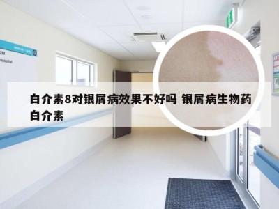 白介素8对银屑病效果不好吗 银屑病生物药白介素