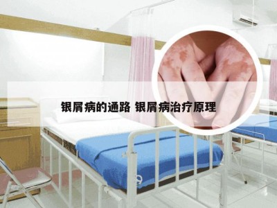银屑病的通路 银屑病治疗原理