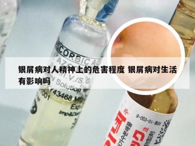 银屑病对人精神上的危害程度 银屑病对生活有影响吗