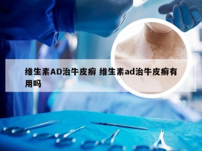 维生素AD治牛皮癣 维生素ad治牛皮癣有用吗