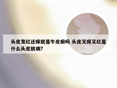 头皮发红还痒就是牛皮癣吗 头皮又痒又红是什么头皮肤病?