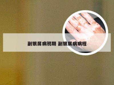 副银屑病初期 副银屑病病程