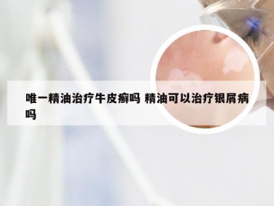 唯一精油治疗牛皮癣吗 精油可以治疗银屑病吗