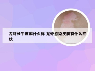 龙虾长牛皮癣什么样 龙虾感染皮肤有什么症状