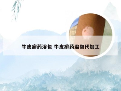 牛皮癣药浴包 牛皮癣药浴包代加工