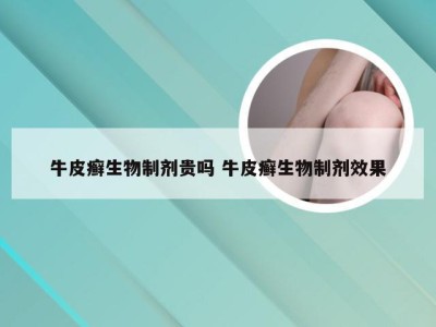 牛皮癣生物制剂贵吗 牛皮癣生物制剂效果