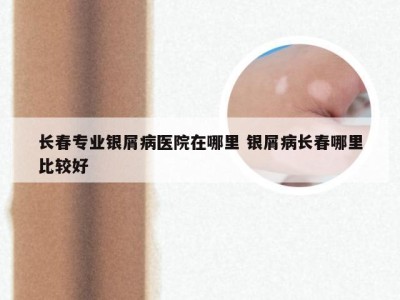 长春专业银屑病医院在哪里 银屑病长春哪里比较好