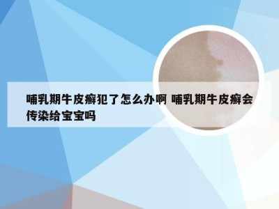 哺乳期牛皮癣犯了怎么办啊 哺乳期牛皮癣会传染给宝宝吗