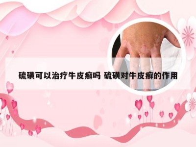 硫磺可以治疗牛皮癣吗 硫磺对牛皮癣的作用